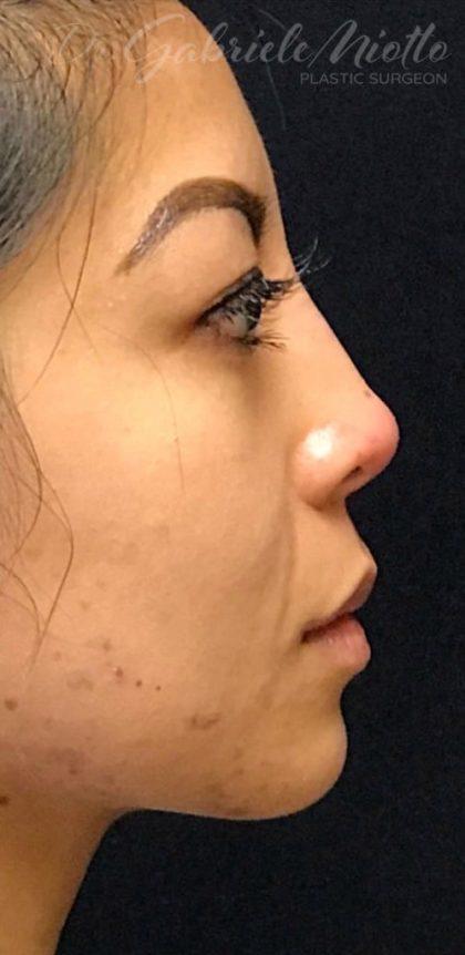 Miotto Plastic Surgery (Dr. Gabriele Miotto) rhinoplasty after — Atlanta, GA