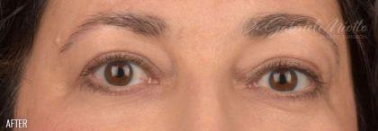 Miotto Plastic Surgery (Dr. Gabriele Miotto) blepharoplasty after — Atlanta, GA