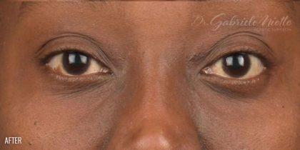 Fat Transfer after at Miotto Plastic Surgery (Dr. Gabriele Miotto) in Atlanta, GA