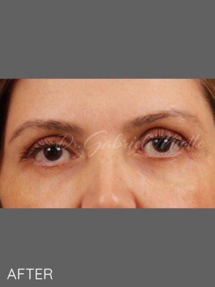 Fat Transfer after at Miotto Plastic Surgery (Dr. Gabriele Miotto) in Atlanta, GA