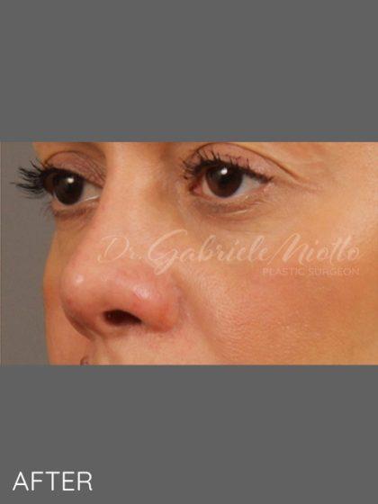 Miotto Plastic Surgery (Dr. Gabriele Miotto) rhinoplasty after — Atlanta, GA