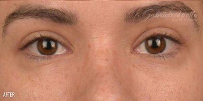 Miotto Plastic Surgery (Dr. Gabriele Miotto) blepharoplasty after — Atlanta, GA