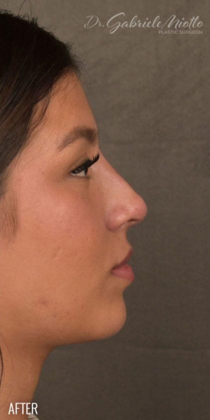 Ethnic Rhinoplasty after at Miotto Plastic Surgery (Dr. Gabriele Miotto) in Atlanta, GA
