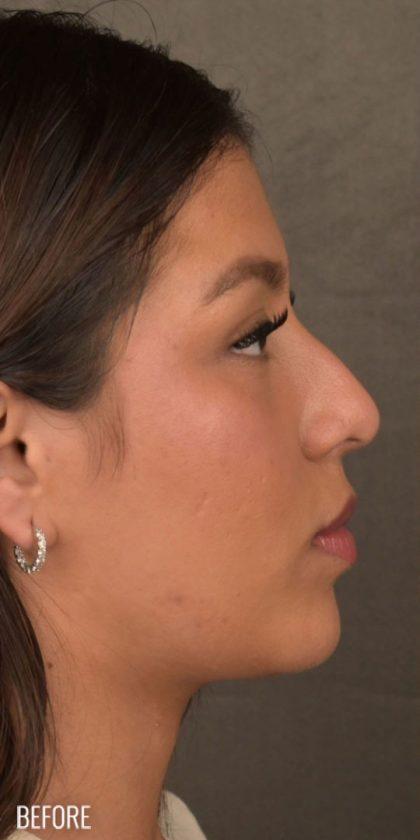 Ethnic Rhinoplasty before at Miotto Plastic Surgery (Dr. Gabriele Miotto) in Atlanta, GA