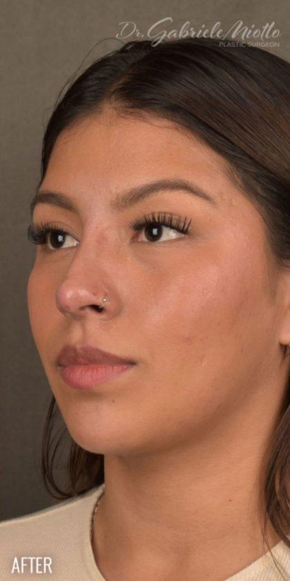 Ethnic Rhinoplasty after at Miotto Plastic Surgery (Dr. Gabriele Miotto) in Atlanta, GA