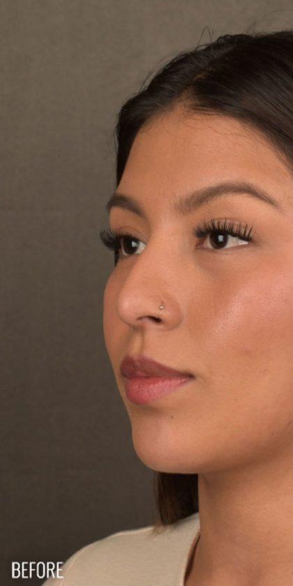 Ethnic Rhinoplasty before at Miotto Plastic Surgery (Dr. Gabriele Miotto) in Atlanta, GA