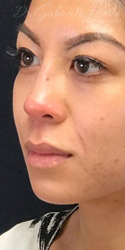 Miotto Plastic Surgery (Dr. Gabriele Miotto) rhinoplasty after — Atlanta, GA