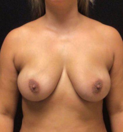 Breast Lift before at Miotto Plastic Surgery (Dr. Gabriele Miotto) in Atlanta, GA