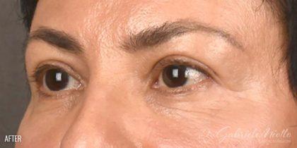 Blepharoplasty after at Miotto Plastic Surgery (Dr. Gabriele Miotto) in Atlanta, GA