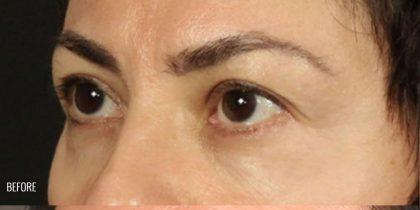Blepharoplasty before at Miotto Plastic Surgery (Dr. Gabriele Miotto) in Atlanta, GA