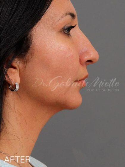 Miotto Plastic Surgery (Dr. Gabriele Miotto) fat transfer after — Atlanta, GA