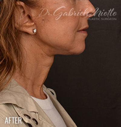 Neck Lift after at Miotto Plastic Surgery (Dr. Gabriele Miotto) in Atlanta, GA