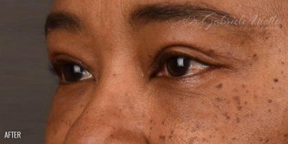 Miotto Plastic Surgery (Dr. Gabriele Miotto) blepharoplasty after — Atlanta, GA