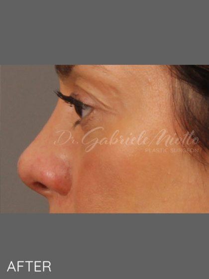 Miotto Plastic Surgery (Dr. Gabriele Miotto) rhinoplasty after — Atlanta, GA