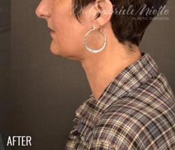 Miotto Plastic Surgery (Dr. Gabriele Miotto) facelift result