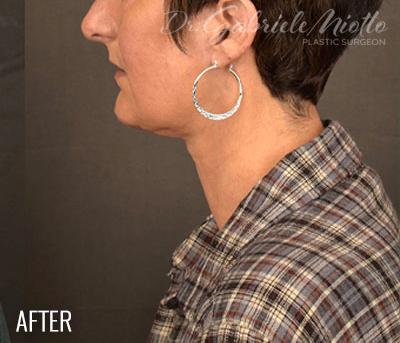 Facelift after at Miotto Plastic Surgery (Dr. Gabriele Miotto) in Atlanta, GA