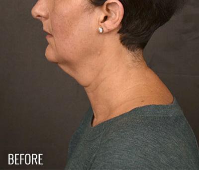 Facelift before at Miotto Plastic Surgery (Dr. Gabriele Miotto) in Atlanta, GA