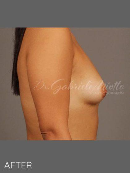 Miotto Plastic Surgery (Dr. Gabriele Miotto) breast augmentation after — Atlanta, GA