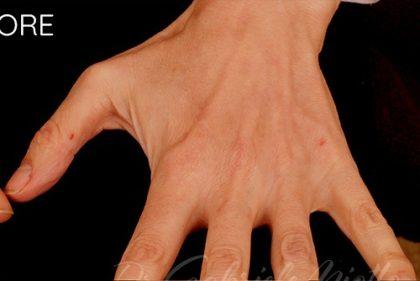 Miotto Plastic Surgery (Dr. Gabriele Miotto) fat transfer after — Atlanta, GA