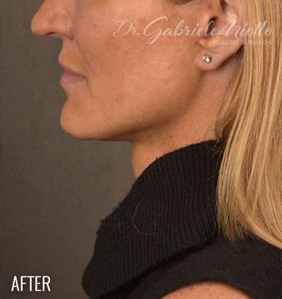 Miotto Plastic Surgery (Dr. Gabriele Miotto) facelift after — Atlanta, GA