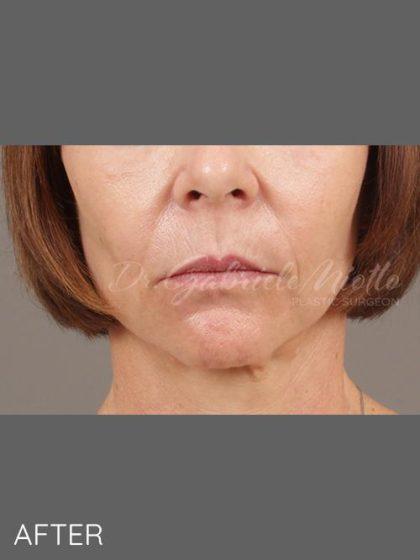 Miotto Plastic Surgery (Dr. Gabriele Miotto) fat transfer after — Atlanta, GA
