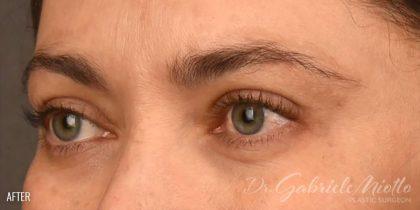 Brow Lift after at Miotto Plastic Surgery (Dr. Gabriele Miotto) in Atlanta, GA