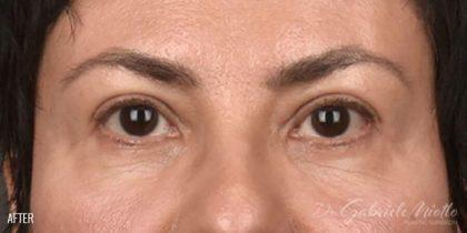 Blepharoplasty after at Miotto Plastic Surgery (Dr. Gabriele Miotto) in Atlanta, GA