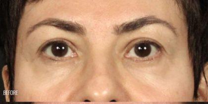 Blepharoplasty before at Miotto Plastic Surgery (Dr. Gabriele Miotto) in Atlanta, GA