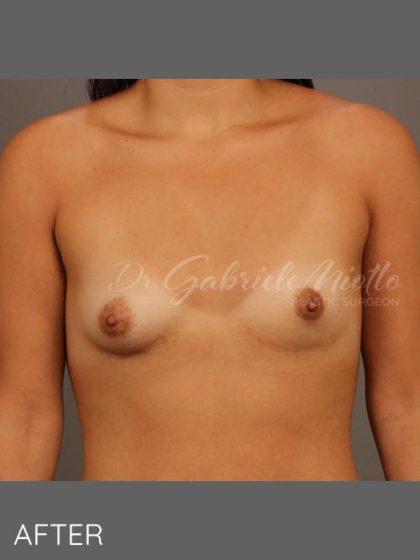 Miotto Plastic Surgery (Dr. Gabriele Miotto) breast augmentation after — Atlanta, GA
