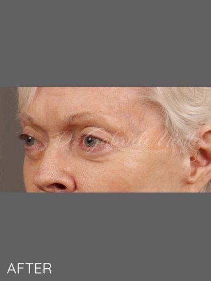 Miotto Plastic Surgery (Dr. Gabriele Miotto) fat transfer after — Atlanta, GA
