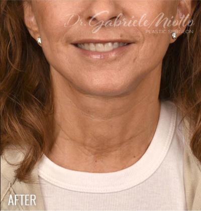 Neck Lift after at Miotto Plastic Surgery (Dr. Gabriele Miotto) in Atlanta, GA