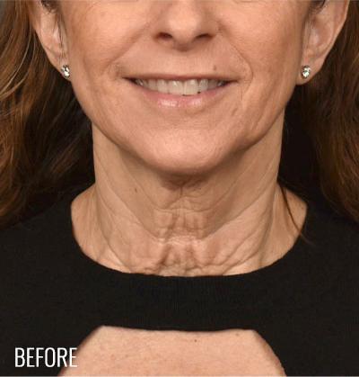 Neck Lift before at Miotto Plastic Surgery (Dr. Gabriele Miotto) in Atlanta, GA