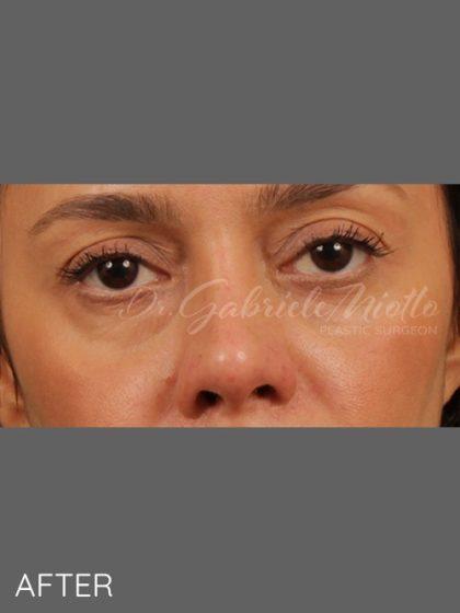Miotto Plastic Surgery (Dr. Gabriele Miotto) rhinoplasty after — Atlanta, GA