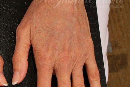 Miotto Plastic Surgery (Dr. Gabriele Miotto) fat transfer after — Atlanta, GA