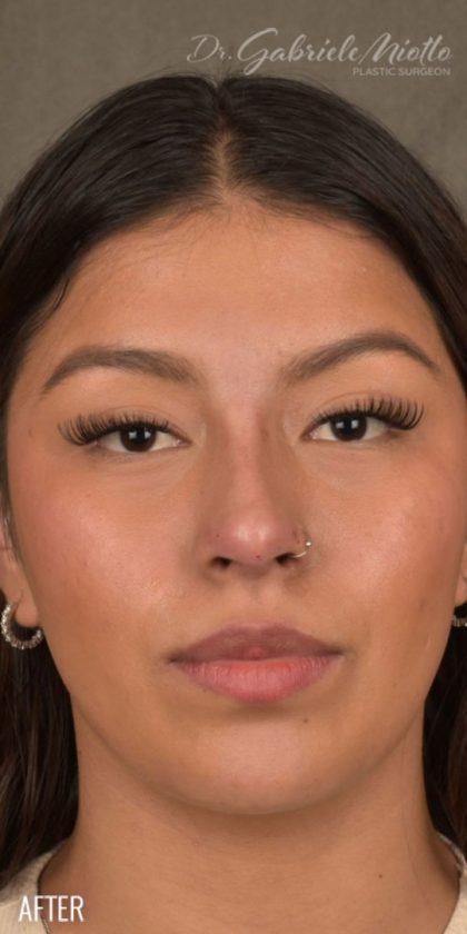 Miotto Plastic Surgery (Dr. Gabriele Miotto) rhinoplasty after — Atlanta, GA