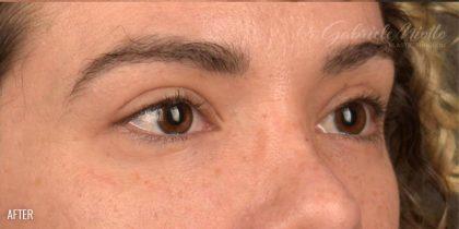 Miotto Plastic Surgery (Dr. Gabriele Miotto) blepharoplasty after — Atlanta, GA