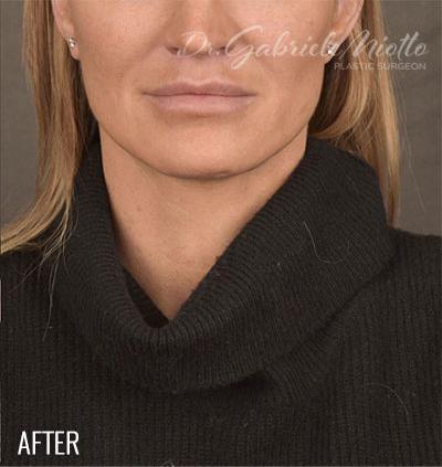 Miotto Plastic Surgery (Dr. Gabriele Miotto) facelift after — Atlanta, GA