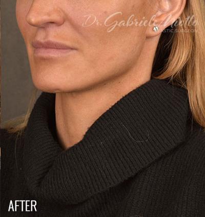 Miotto Plastic Surgery (Dr. Gabriele Miotto) facelift after — Atlanta, GA