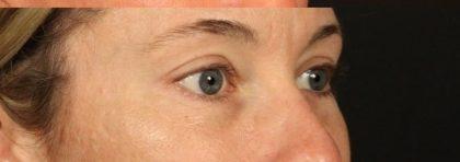 Brow Lift after at Miotto Plastic Surgery (Dr. Gabriele Miotto) in Atlanta, GA