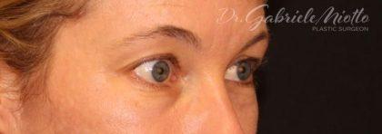 Brow Lift before at Miotto Plastic Surgery (Dr. Gabriele Miotto) in Atlanta, GA
