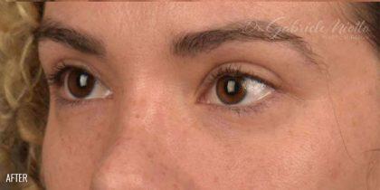 Miotto Plastic Surgery (Dr. Gabriele Miotto) blepharoplasty after — Atlanta, GA