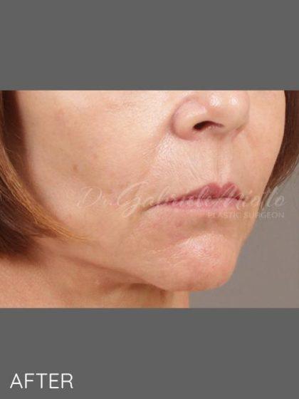 Fat Transfer after at Miotto Plastic Surgery (Dr. Gabriele Miotto) in Atlanta, GA