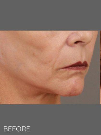 Fat Transfer before at Miotto Plastic Surgery (Dr. Gabriele Miotto) in Atlanta, GA