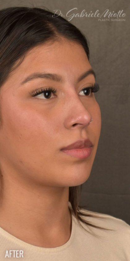 Ethnic Rhinoplasty after at Miotto Plastic Surgery (Dr. Gabriele Miotto) in Atlanta, GA