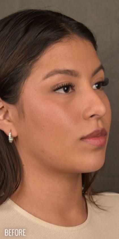 Ethnic Rhinoplasty before at Miotto Plastic Surgery (Dr. Gabriele Miotto) in Atlanta, GA
