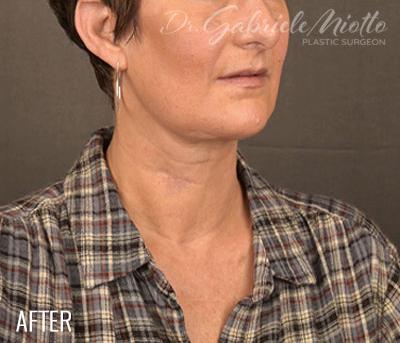 Miotto Plastic Surgery (Dr. Gabriele Miotto) facelift after — Atlanta, GA