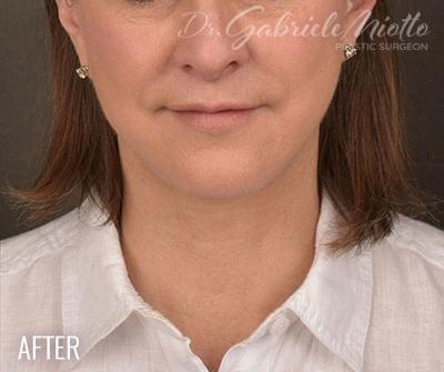 Miotto Plastic Surgery (Dr. Gabriele Miotto) facelift after — Atlanta, GA