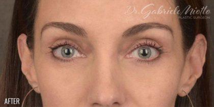 Fat Transfer after at Miotto Plastic Surgery (Dr. Gabriele Miotto) in Atlanta, GA