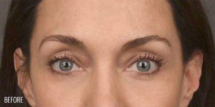 Fat Transfer before at Miotto Plastic Surgery (Dr. Gabriele Miotto) in Atlanta, GA
