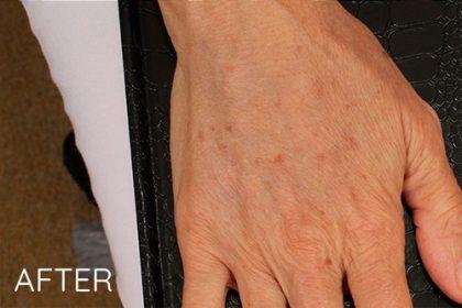 Miotto Plastic Surgery (Dr. Gabriele Miotto) fat transfer after — Atlanta, GA